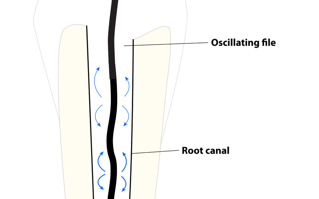 Ultrasonic Cleaning of Root Canals